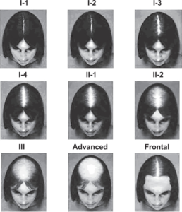 Savin scale showing stages of Female pattern baldness